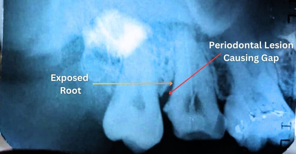 Xray showing exposed root and periodontal lesion X-Ray showing exposed root and periodontal lesion