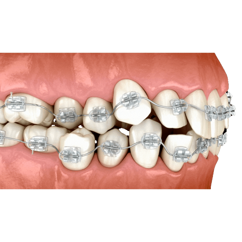 braces cost in dhaka bangladesh