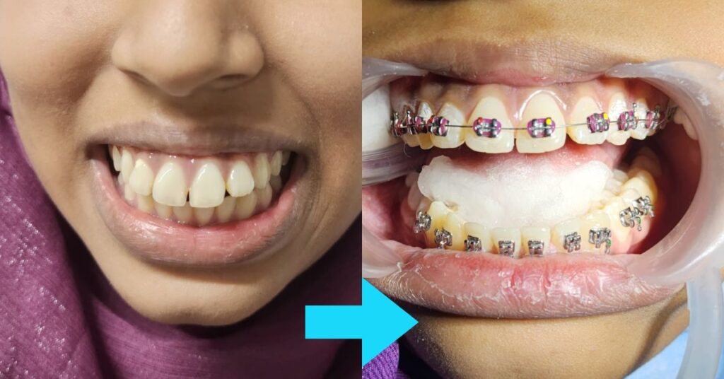 braces in Mirpur, Dhaka, Bangladesh