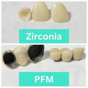 zirconia cap in dhaka, bangladesh