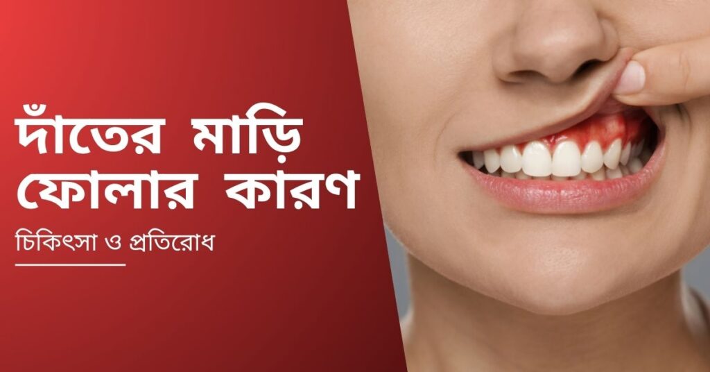 দাঁতের মাড়ি ফোলার কারন