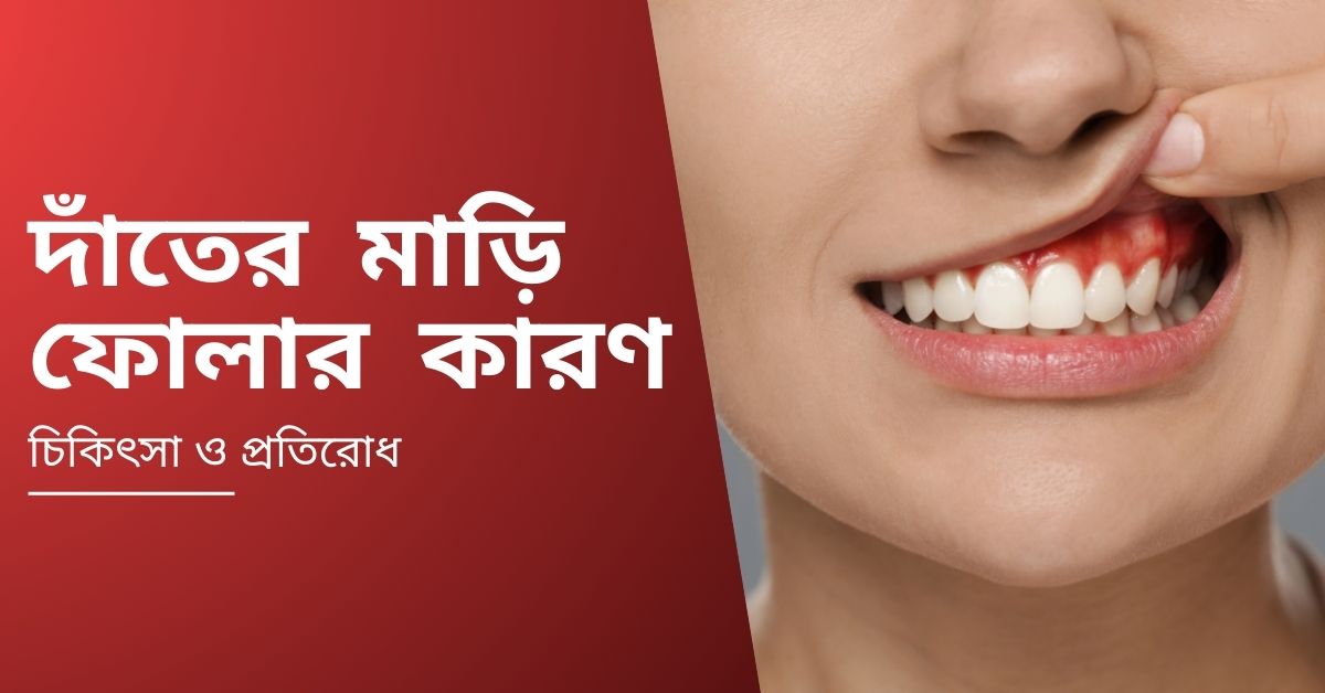 দাঁতের মাড়ি ফোলার কারন
