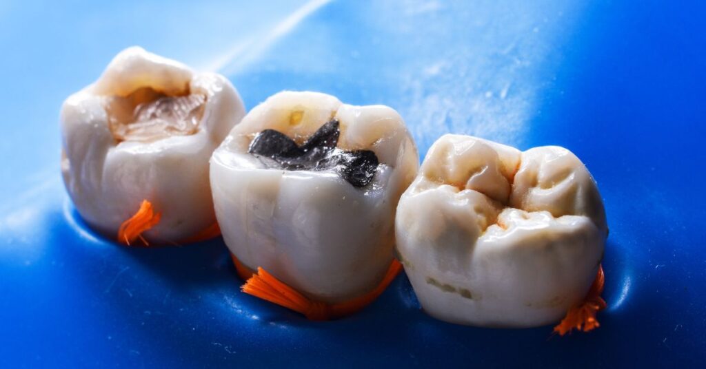 amalgam filling in Bangladesh