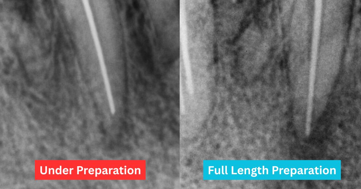 Full length tooth preparation during root canal treatment in Mirpur Lumika Dental