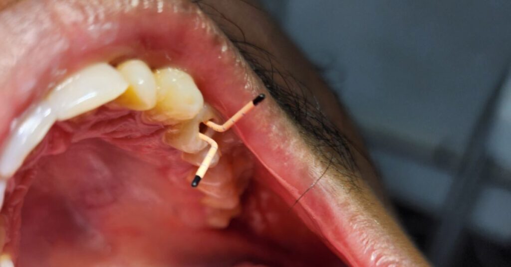 Painless root canal in mirpur dhaka being done at Lumika Dental Mirpur 11