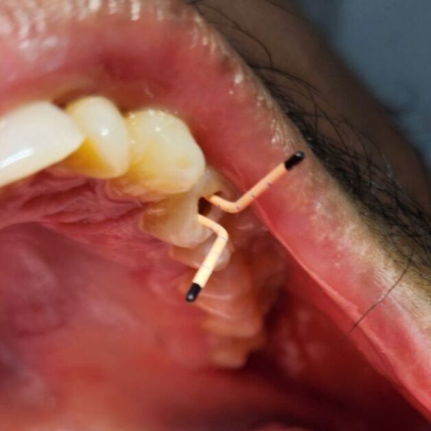 Painless root canal in mirpur dhaka being done at Lumika Dental Mirpur 11