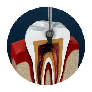 root canal treatment in mirpur, dhaka
