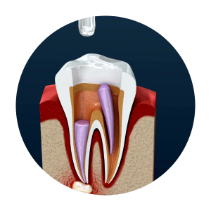 root canal in dhaka