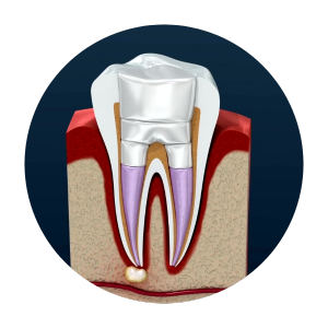 root canal treatment in Dhaka