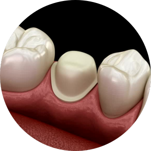 crown preparation