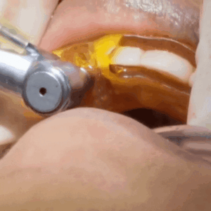 guided implant in bangladesh