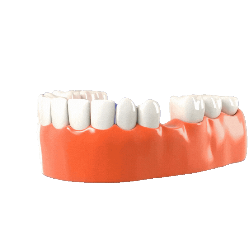 implant in Bangladesh