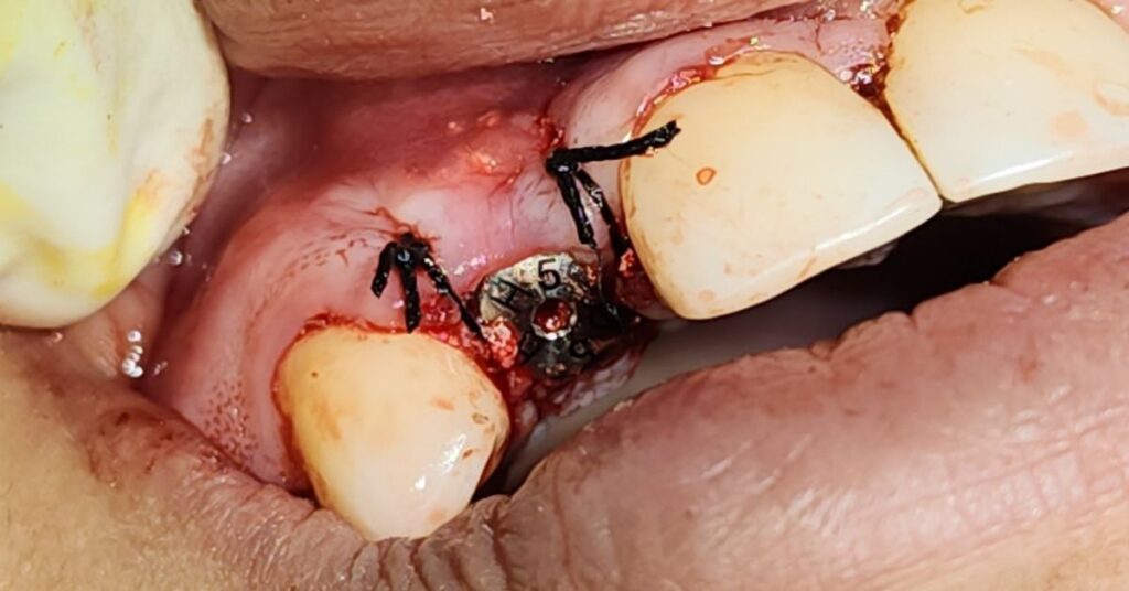 dental implant in bangladesh at Lumika Dental