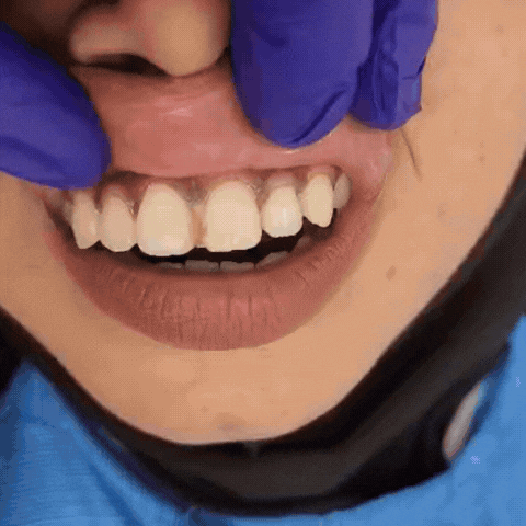 tooth gap filling in Dhaka