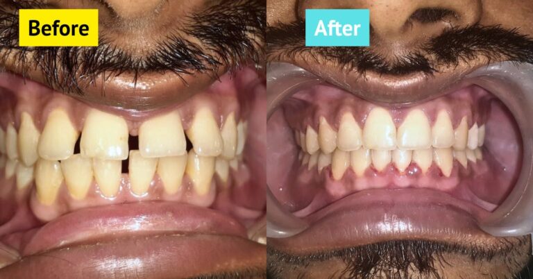 tooth gap treatment in dhaka