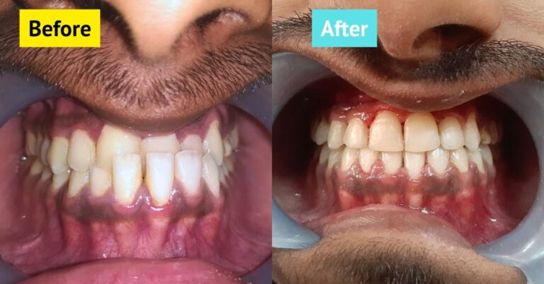 braces in bangladesh