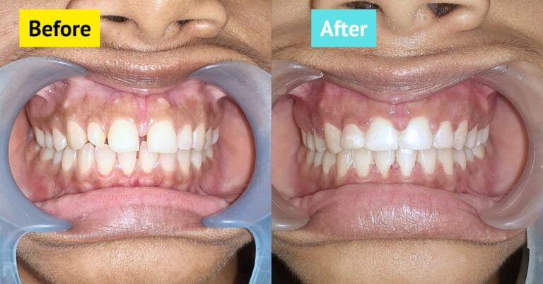 tooth gap treatment in mirpur