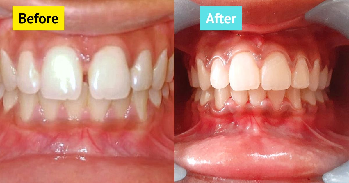 tooth gap braces braces in Dhaka