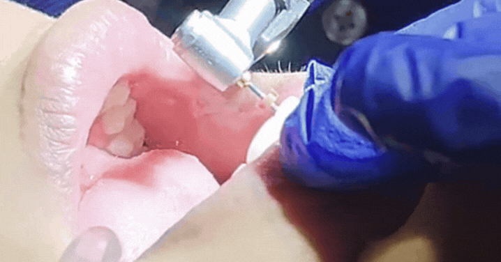 endomotor root canal treatment in Dhaka