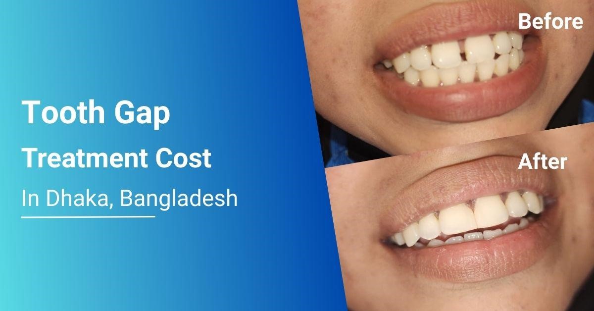 tooth gap treatment bangladesh