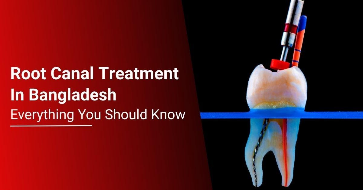 root canal treatment in bangladesh