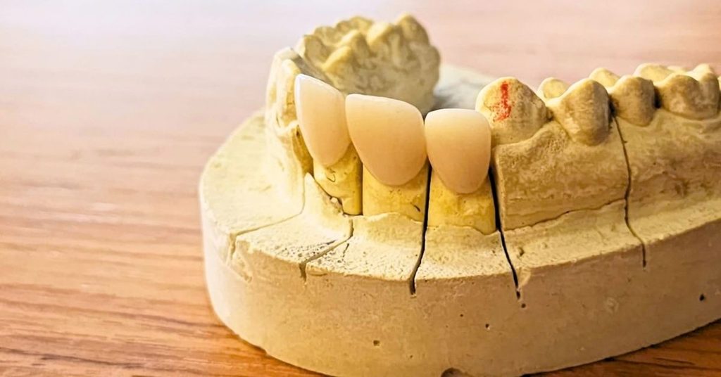 zirconia crown bangladesh
